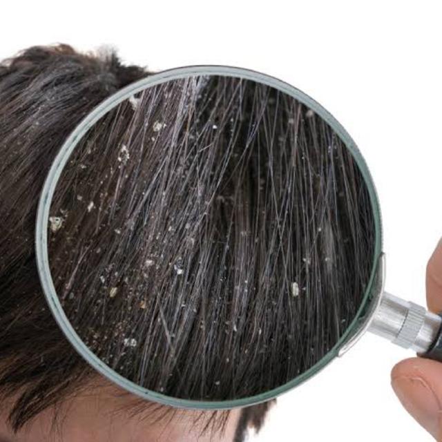 Hair dandurf treatment