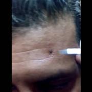  Face warts removal per wart