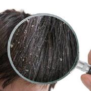 Hair dandurf treatment